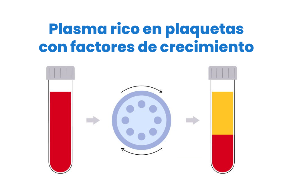 PRP - Plasma Rico en Plaquetas paso 1
