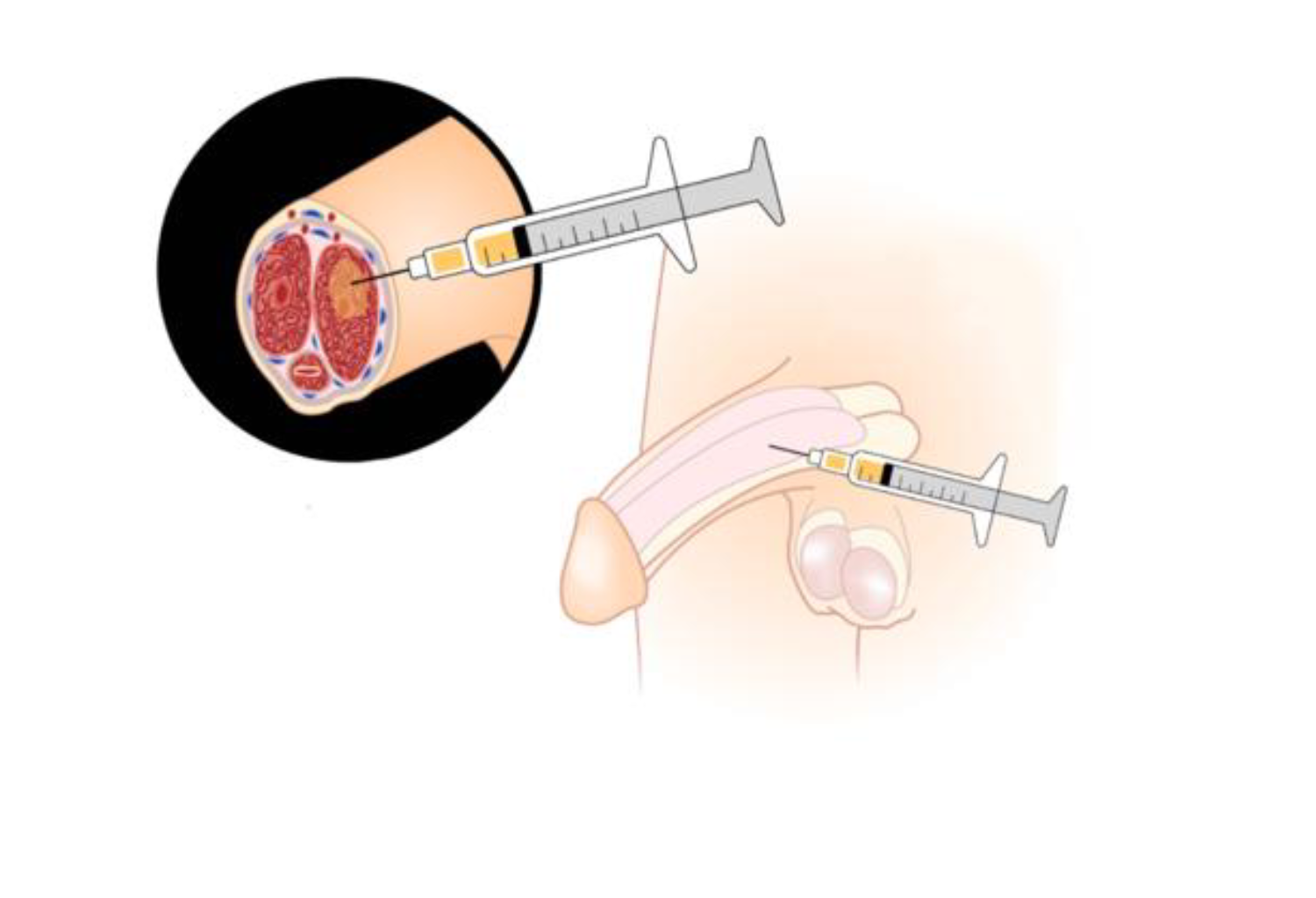 PRP - Plasma Rico en Plaquetas paso 3
