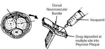 iontoforesis