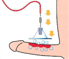 iontoforesis