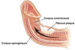 peyronie